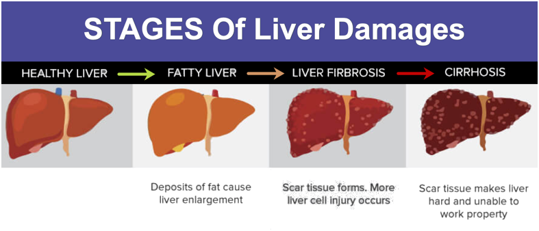 Fatty Liver–Symptoms, Causes & All-Natural Support Strategies | FindBMI.net